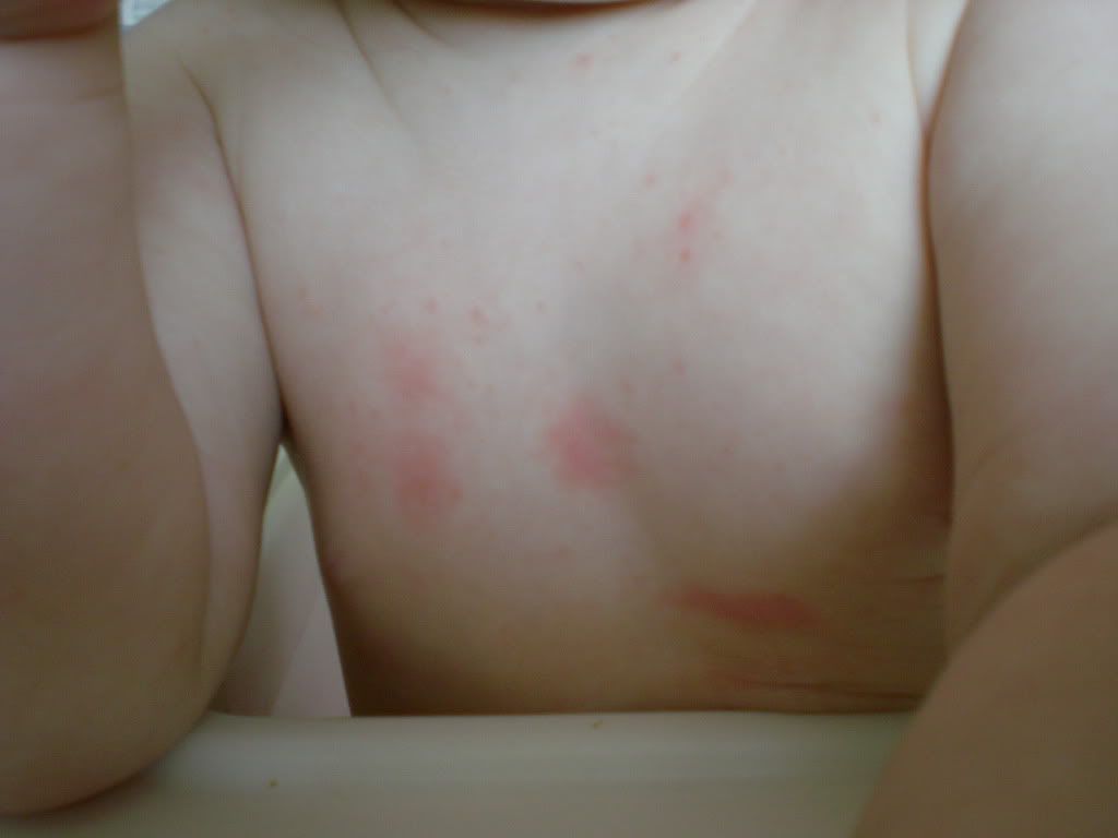 Splotches On Chest